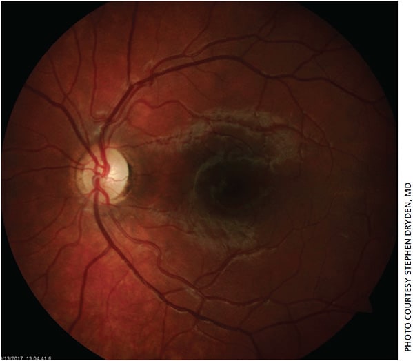 Figure 4. Fundus photo OS showing a normal-appearing posterior pole.