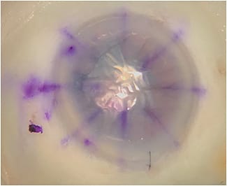 Figure 3. The anterior chamber has full air fill to achieve a physiologic IOP. The DMEK graft has lost most of its stain, but the S stamp remains legible.