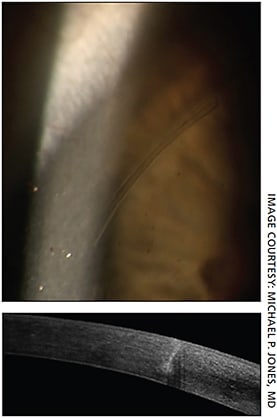 Figures 5 and 6. Femto-cut arcuate incisions. Note uniform depth and square edge.