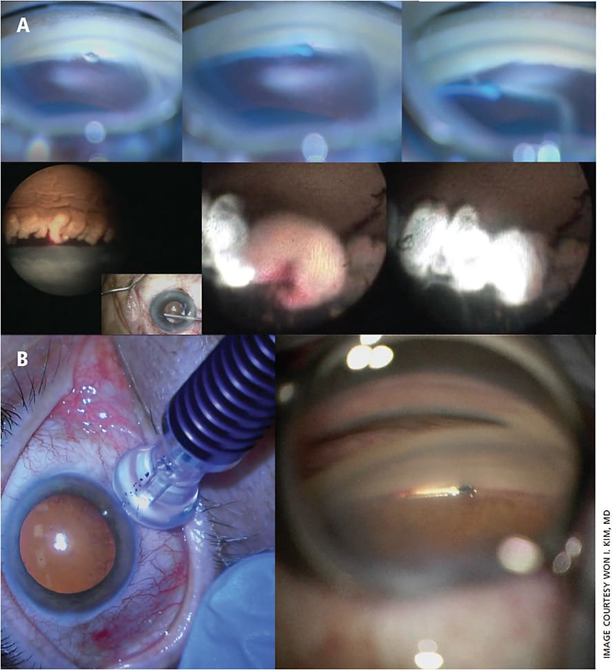 Figure 1. Trabecular meshwork bypass technique combined with CPC. A. Trab 360 (Sight Sciences) circumferential trabeculotomy combined with endoscopic cyclophotocoagulation (Endo Optiks). B. Micropulse (Iridex) combined with Hydrus (Ivantis).