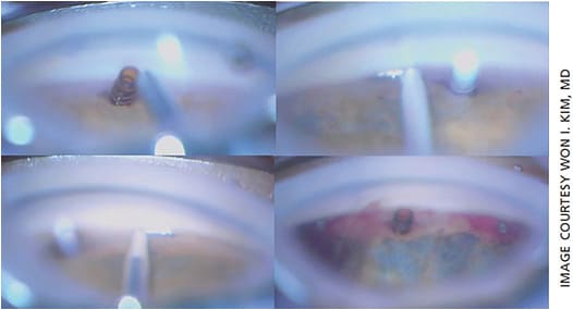 Figure 2. CyPass (Alcon) combined with two first-generation iStents (Glaukos).