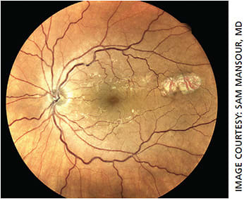 Figure 3. Amelanotic congenital hypertrophy of retinal pigment epithelium. Left eye of patient with a nuclear sclerotic cataract imaged with Icare USA Eidon TrueColor Confocal Scanner.