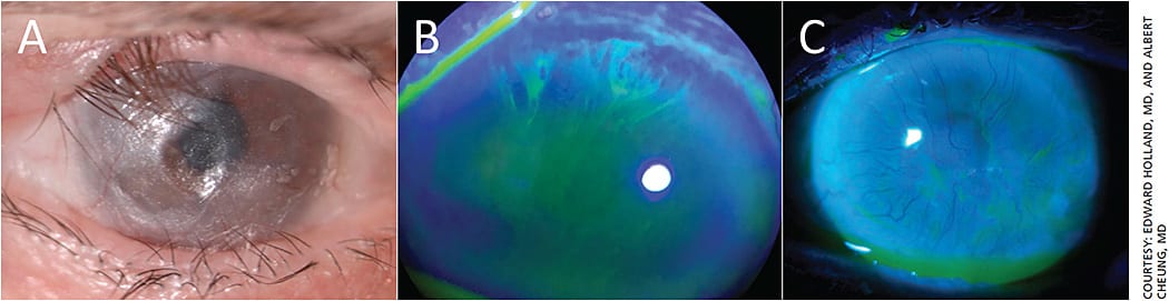 Figure 1. A. Slit lamp photograph of an eye with severe MMP; note the keratinized ocular surface and cicatricial entropion. B. Slit lamp photograph demonstrating superior, sectoral late staining with a whorl-like pattern of increased elevated fluorescein uptake. C. Slit lamp photograph demonstrating a failed ocular surface with diffuse late staining, conjunctivalization and vascularization.