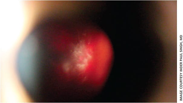 Figure 4. Slit lamp is 10° oblique (off axis). This titrates off some of the anterior illumination but keeps enough posterior illumination to see if the retina is in focus or not, which helps to maximize contrast with the floater and still provide spatial context (retina is far enough away).