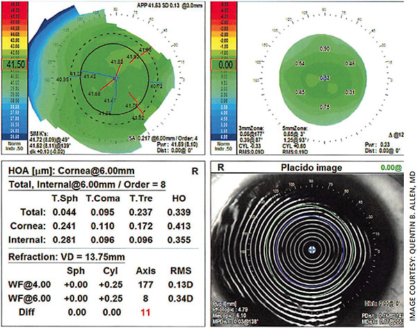 Figure 3. Postoperative topography and wavefront aberrometry.