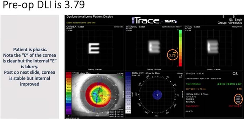 Figure 13. Preop LFT case showing DLI of 3.79 and HOA of the internal optical system is 0.195. Autorefraction and topography are also shown.