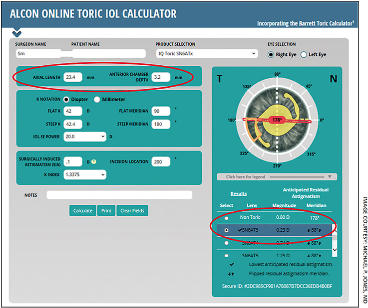Figure 2. Results with Alcon’s Online Toric IOL Calculator, which takes PCA into account. A T3 Toric IOL was recommended.
