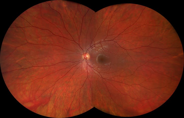 Figure 2. Ultra-widefield image of normal retina with Zeiss Clarus camera.(Image courtesy of Zeiss)