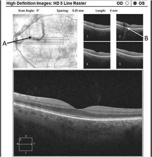 Figure 11. Above: Arrow A indicates large opacity over the macula region. Shadow is seen being case over the macula on the 5 line raster scans. See arrow B.