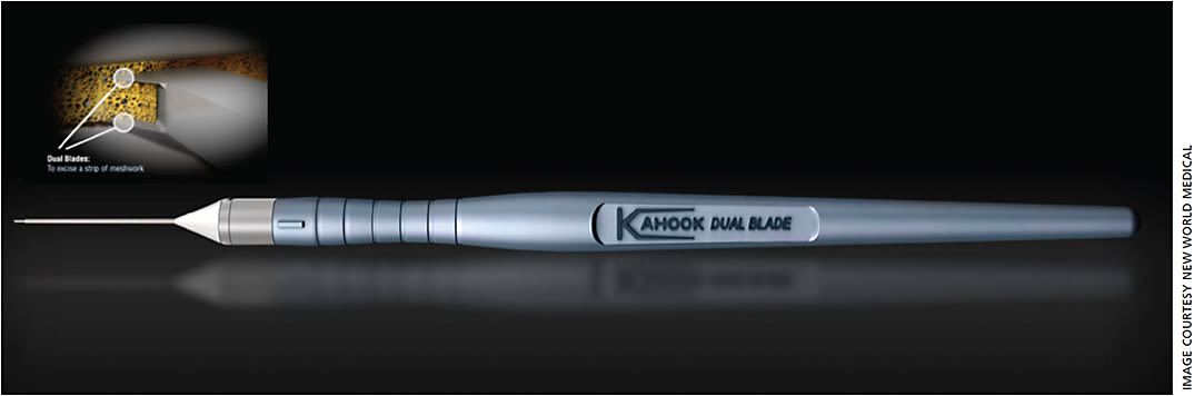 Figure 1. The KDB device is a single-use ophthalmic blade that is precision engineered for removal of trabecular meshwork while minimizing residual leaflets.