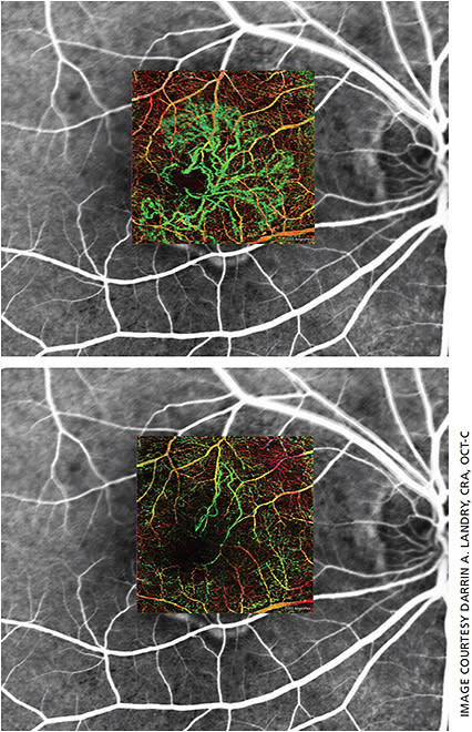 Figure 4. OCTA depth encoded overlayed on fluorescein angiogram pretreatment (top) and posttreatment (bottom) demonstrating a difference in lesion size. Note: overlaying software is not available — these images were created for educational purposes.