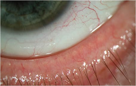 Figure 3. Telangiecatasias in a patient with rosacea