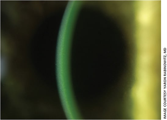 A precisely timed beam of ultraviolet-A light is applied to strengthen mechanical properties of the cornea.