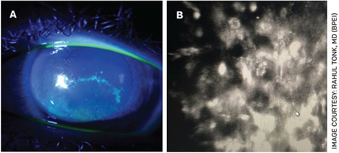 FIGURE 1. Fluorescein slit lamp photograph of a patient with a pseudodendrite initially diagnosed as HSV keratitis (A). After limited response to HSV treatment, confocal microscopy revealed the presence of Acanthamoeba cysts (B).