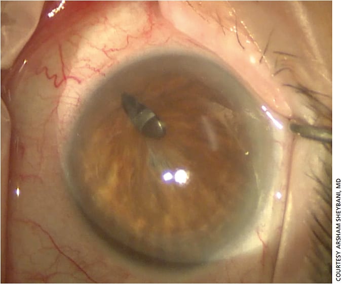 Figure 4. Corectopia with monocular diplopia after cataract surgery.
