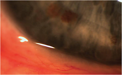 Figure 4. Patient with conjunctivochalasis