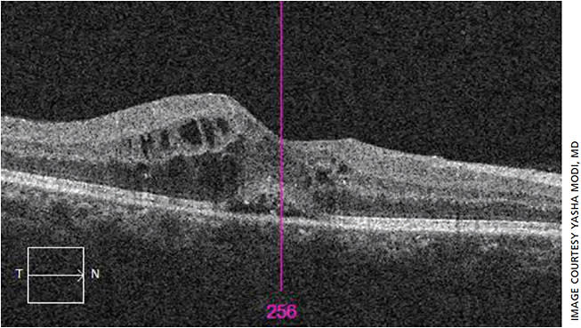 Figure 2. Despite three monthly anti-VEGF injections, there is persistent macular edema and subretinal fluid seen on the SD-OCT.