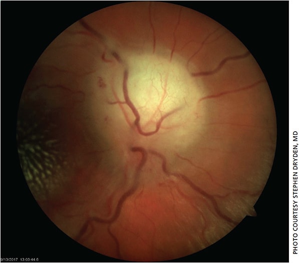 Figure 1. Optic nerve head photo OD showing optic nerve head edema with blurring of disc margins.