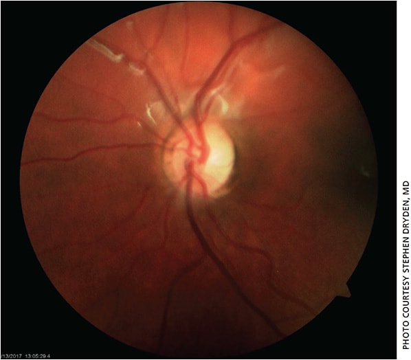 Figure 2. Optic nerve head photo OS showing normal-appearing optic nerve head.