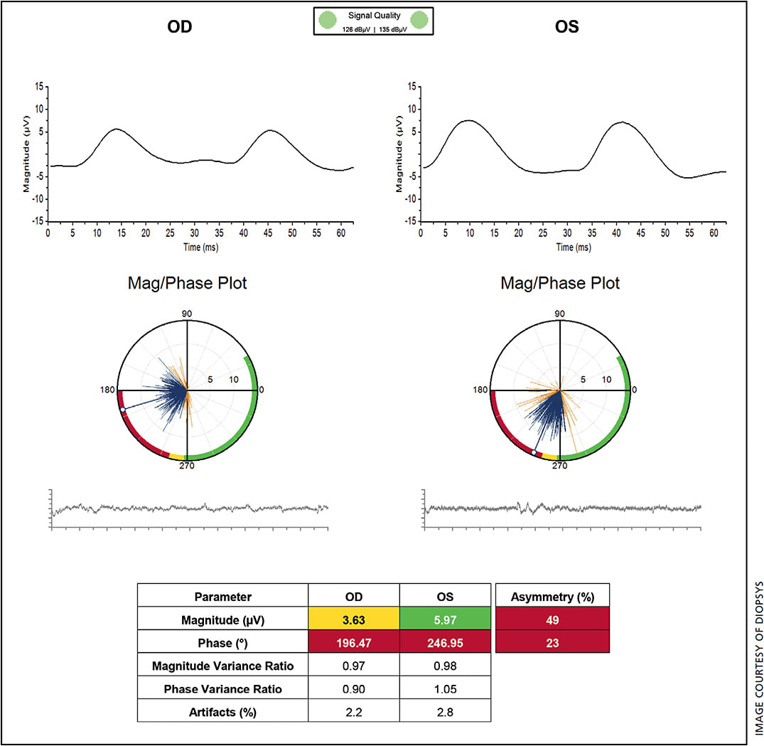 Figure 1. An example of “abnormal” Diopsys ffERG/Fixed Luminance Flicker test result. Results of eyes with retinal dysfunction often show a wide “fan” of individual responses grouped mostly toward the left side of the Mag/Phase Plot and parameters out-of-range (red) or borderline (yellow) within the data table.