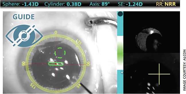Alcon’s ORA System features VerifEye+ technology for guidance and verification during refractive cataract surgery.