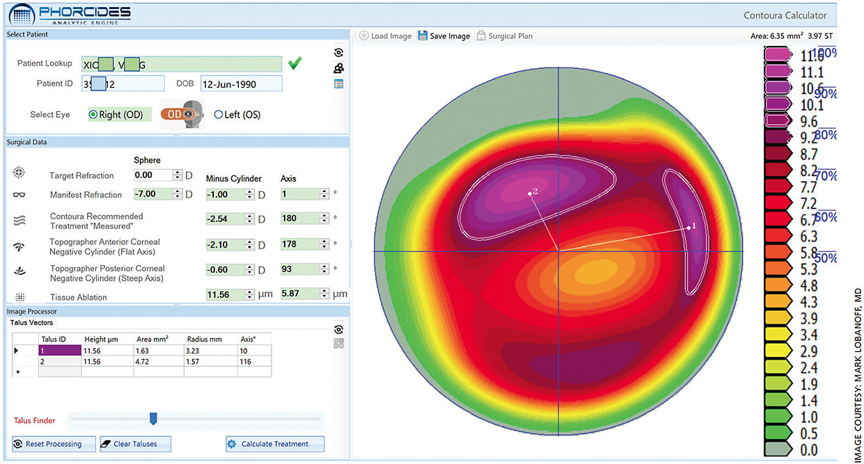 Figure 3. An image from the Phorcides Analytic Engine, developed by Mark Lobanoff, MD, to assist with topography-guided surgeries.