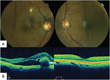 Figure 7. Polyp in polypoidal choroidal vasculopathy.