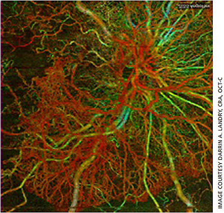 Figure 6. Color depth-encoded OCTA of the optic nerve head with neovascular vessels in red.