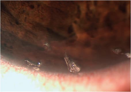 Figure 2. Filaments in an individual with aqueous tear deficiency