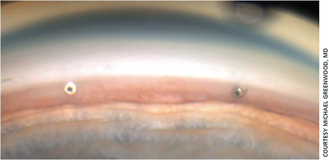 Figure 1. iStent inject (Glaukos).