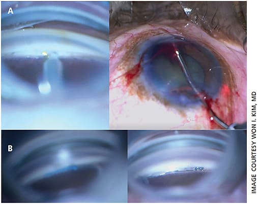 Figure 3. Ab interno canaloplasty (AbIC) combined with trabecular meshwork bypass. A. Trabectome combined with AbIC using lighted microcatheter (Sight Sciences). B. Omni (Sight Sciences) combined with Hydrus (Ivantis).