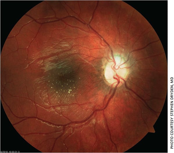 Figure 6. Fundus photo OD showing resolved optic nerve head edema and macular exudates.