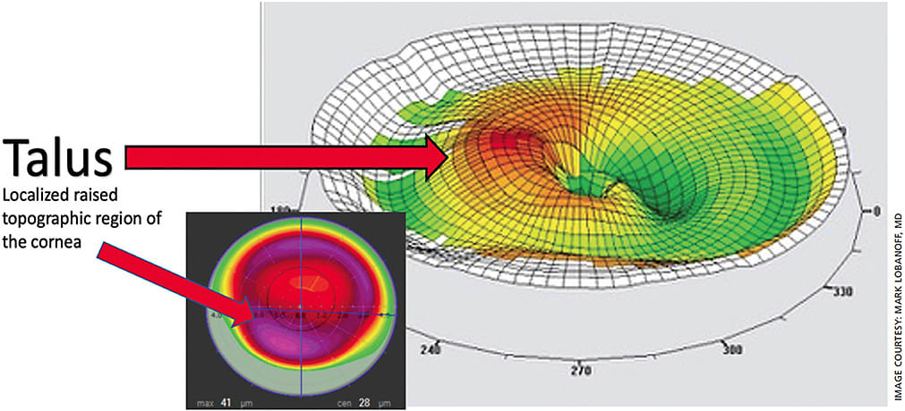 Figure 2. An image of a talus on the eye, created by the Alcon Vario software.