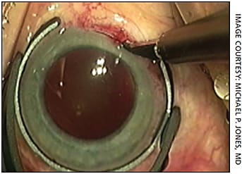Figure 4. A hand-cut limbal relaxing incision using a guarded diamond blade knife.