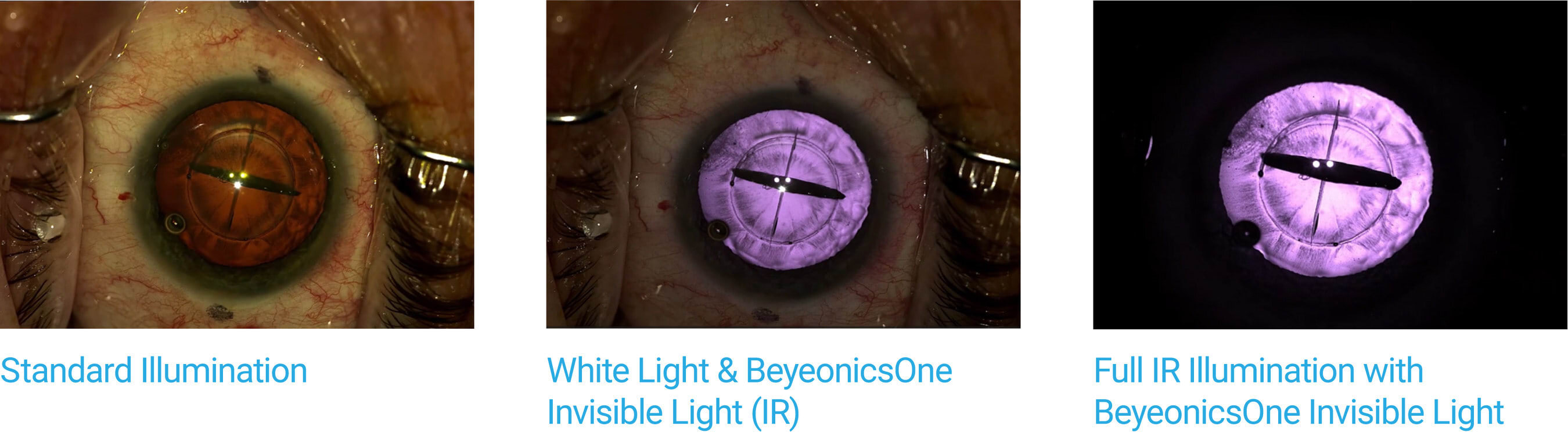 Advancing ophthalmic visualization with Beyeonics One Invisible Light