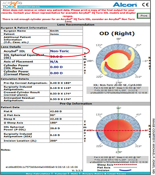 Figure 1. Results with Alcon’s Legacy Toric calculator, which does not take PCA into account. A non-toric IOL was recommended.