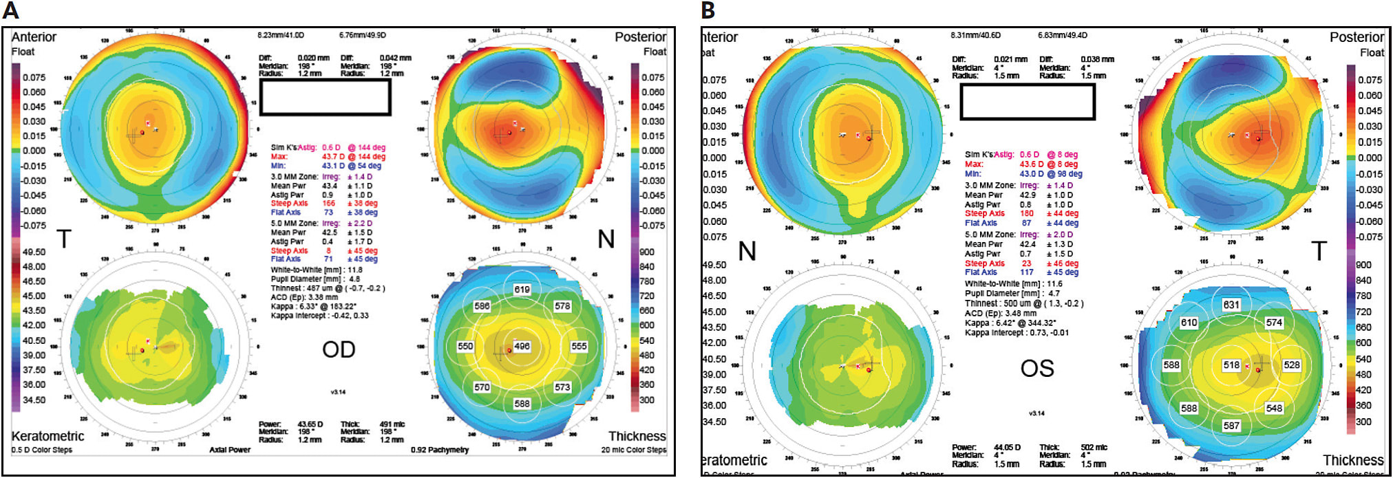 FIGURE 1A AND 1B anteriorly demonstrates ~ 0.6 D against-the-rule astigmatism OU with slightly truncated and skewed bowties; left is greater than the right eye.