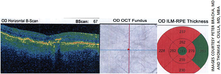 Figure 2. Spectral-domain OCT of the patient’s right macula: The central subfield thickness was 241 μm. Examination of multiple macular cross sections revealed generalized thinning of the retina, drusen, minimal subretinal hyper-reflective material (SHRM) and no exudation.