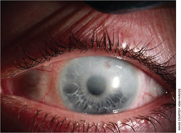 Figure 1. External photograph of patient’s left eye. Superficial and deep corneal neovascularization was noted. Moderate corneal haze was present superiorly and laterally. There was a ghost vessel extending vertically through the visual axis.