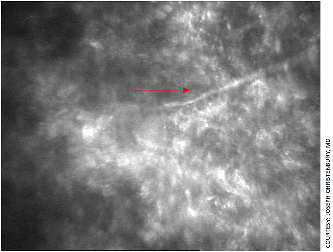 Figure 4. Confocal microscopy image of branching filaments of Fusarium keratitis