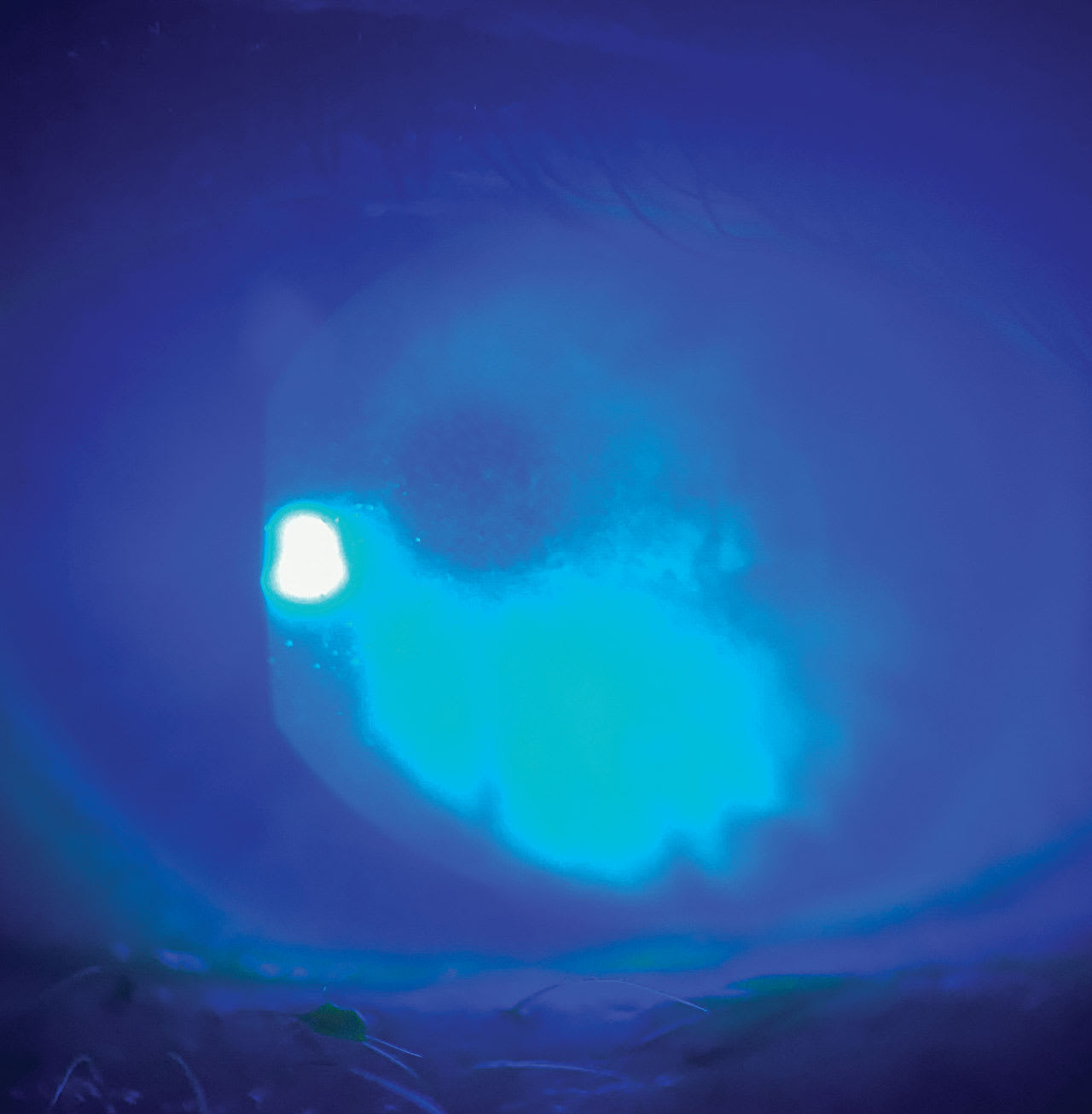 Note the corneal staining here, which is indicative of DED. (Photo courtesy: Pamela E. Theriot, OD, FAAO)