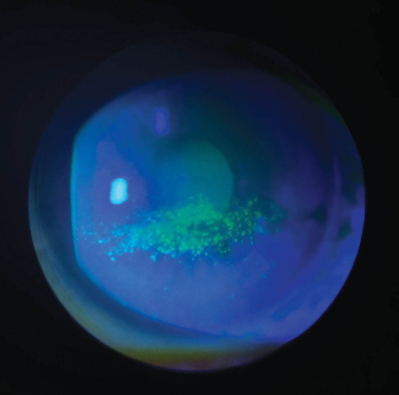 Notice that the confluent area of staining is more central. This finding differentiates NK from  keratoconjunctivitis sicca where the staining is more often found in the inferior portion of the cornea. (Photo courtesy: Dr. Theriot)