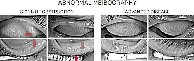 Figure 3. Meibography reveals the signs of meibomian gland dysfunction: gland obstruction, convolution, tortuosity, dropout, and dilated ducts.