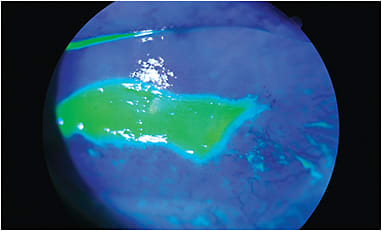 Staining on a cornea shows severe HSV keratitis.
Courtesy of Josh Johnston, O.D., F.A.A.O.