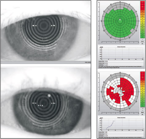 Figure 5. Non-invasive tear break-up time measurement shows an intact corneal surface and a surface with a depleted moisture barrier.