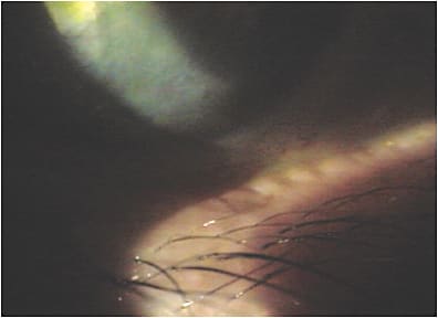 Note the tear instability that results from lid disease.
PHOTO CREDIT: Art Epstein, O.D. F.A.A.O.