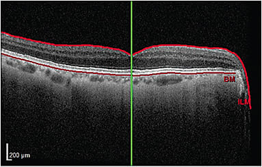 A patient who has primary open angle glaucoma.
Couretsy of Justin Schweitzer, O.D., F.A.A.O.