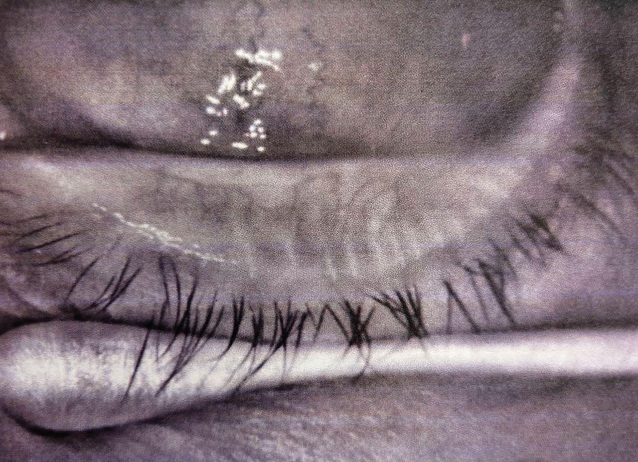 Meibomian gland dysfunction, shown here, falls under TFOS DEWS III eyelid anomalies. (Photo courtesy: Pamela E. Theriot, OD)