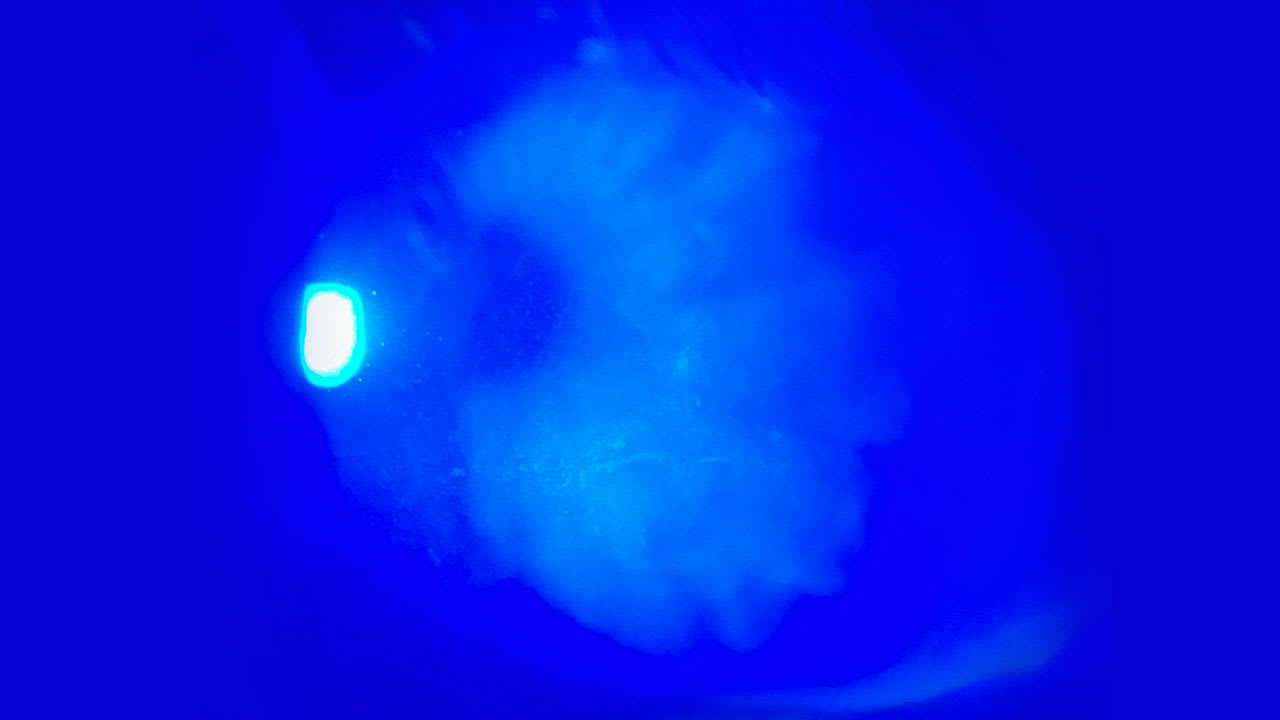 Note the SPK inferior to a 2 mm area of persistent epithelial defects in this DK patient.  (Photo courtesy: Dr. Theriot.)