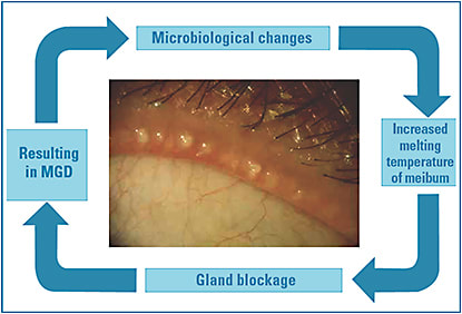 Figure 2. MGD can begin with microbial changes at the eyelid margin.